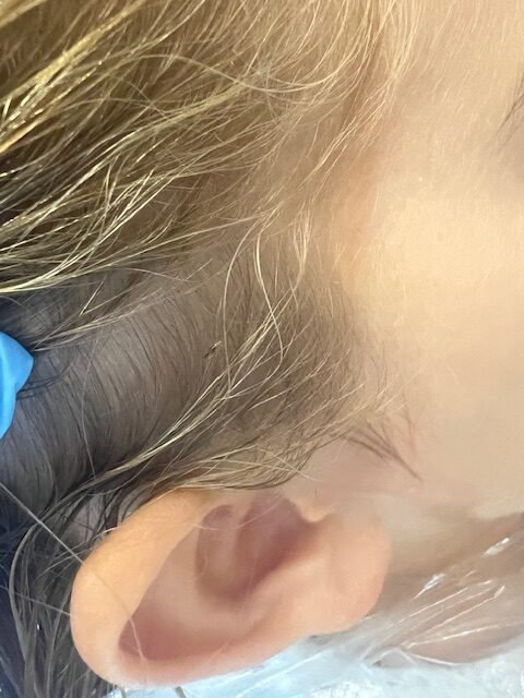 How to Tell if You Have Head Lice: Signs Birmingham Parents Should Know